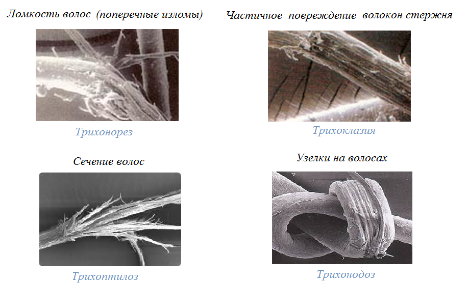 Трихоклазия
